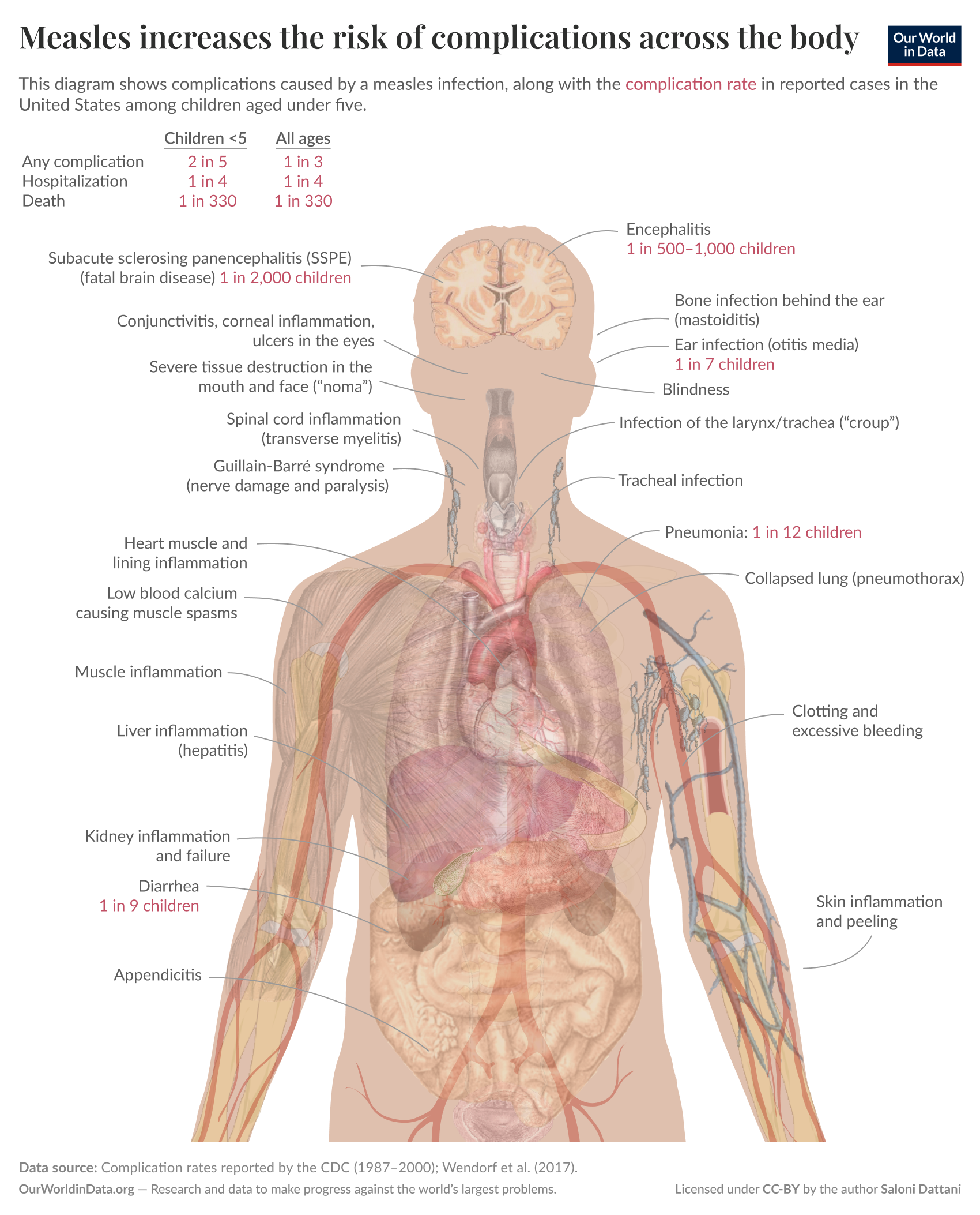This diagram illustrates the complications caused by a measles infection in children under five and shows the complication rates reported in the United States. The central figure is a transparent outline of a human body, highlighting various organs and areas affected by measles.

Above the head, there are labels indicating complications such as encephalitis, which occurs in 1 in 500 to 1,000 children, and various types of infections, including ear infections (otitis media) affecting 1 in 7 children.
In the chest and abdominal area, complications like pneumonia, which affects 1 in 12 children, kidney inflammation and failure, and diarrhea impacting 1 in 9 children are noted. 

Other complications include:
- Subacute sclerosing panencephalitis (fatal brain disease) in 1 in 2,000 children.
- Conjunctivitis and corneal inflammation causing eye issues.
- Muscle inflammation, liver inflammation (hepatitis), and low blood calcium leading to muscle spasms.
- Skin inflammation and peeling, as well as complications such as appendicitis.

The text also provides general statistics for children under five, stating their rates of hospitalization (1 in 4) and death (1 in 330), compared to all ages.

Data sources for the information include complication rates reported by the CDC from 1987 to 2000 and findings from Wendorf et al. (2017). The diagram is licensed under Creative Commons by the author, Saloni Dattani.